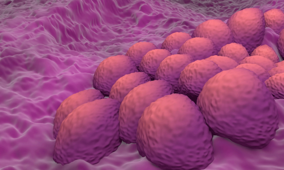 Investigadores desarrollan modelo de IA para detectar cancer endometrial con alta precision