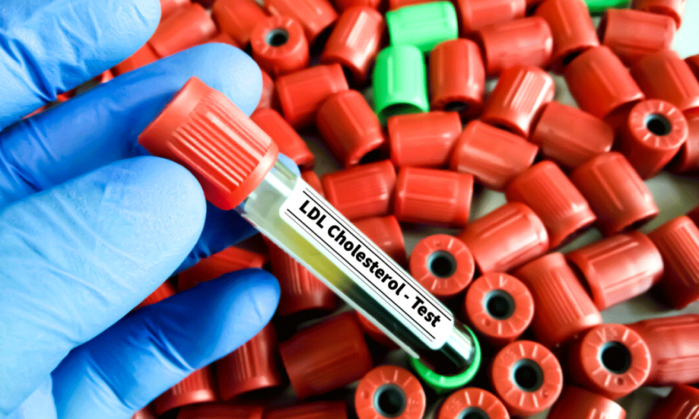 Nuevo medicamento oral logra reducir hasta un 60% el colesterol LDL en pacientes resistentes a estatinas 1