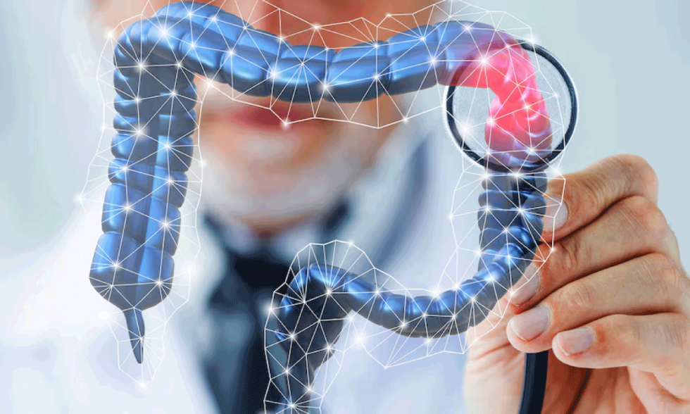 Preocupante aumento de cancer colorrectal en menores de 50 anos Nuevos hallazgos reavivan debate sobre edad de deteccion